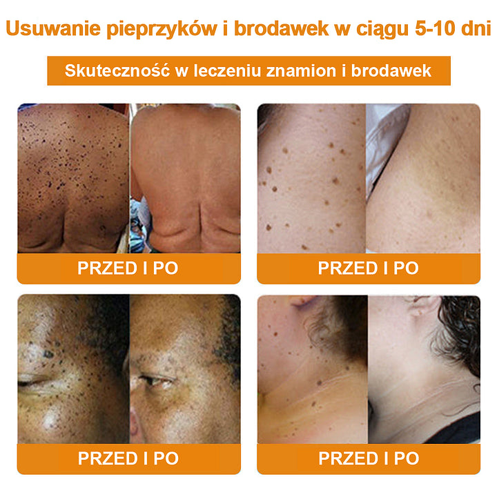 【🌊 Za pobraniem🌊 】 Vsoxa™ Krem do usuwania brodawek i pieprzyków z jadem pszczelim (👨⚕Zalecenia AAD) 🐝🐝 (🔥Ostatni dzień wyprzedaży 70% taniej)