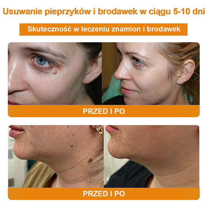 【🌊 Za pobraniem🌊 】 Vsoxa™ Krem do usuwania brodawek i pieprzyków z jadem pszczelim (👨⚕Zalecenia AAD) 🐝🐝 (🔥Ostatni dzień wyprzedaży 70% taniej)