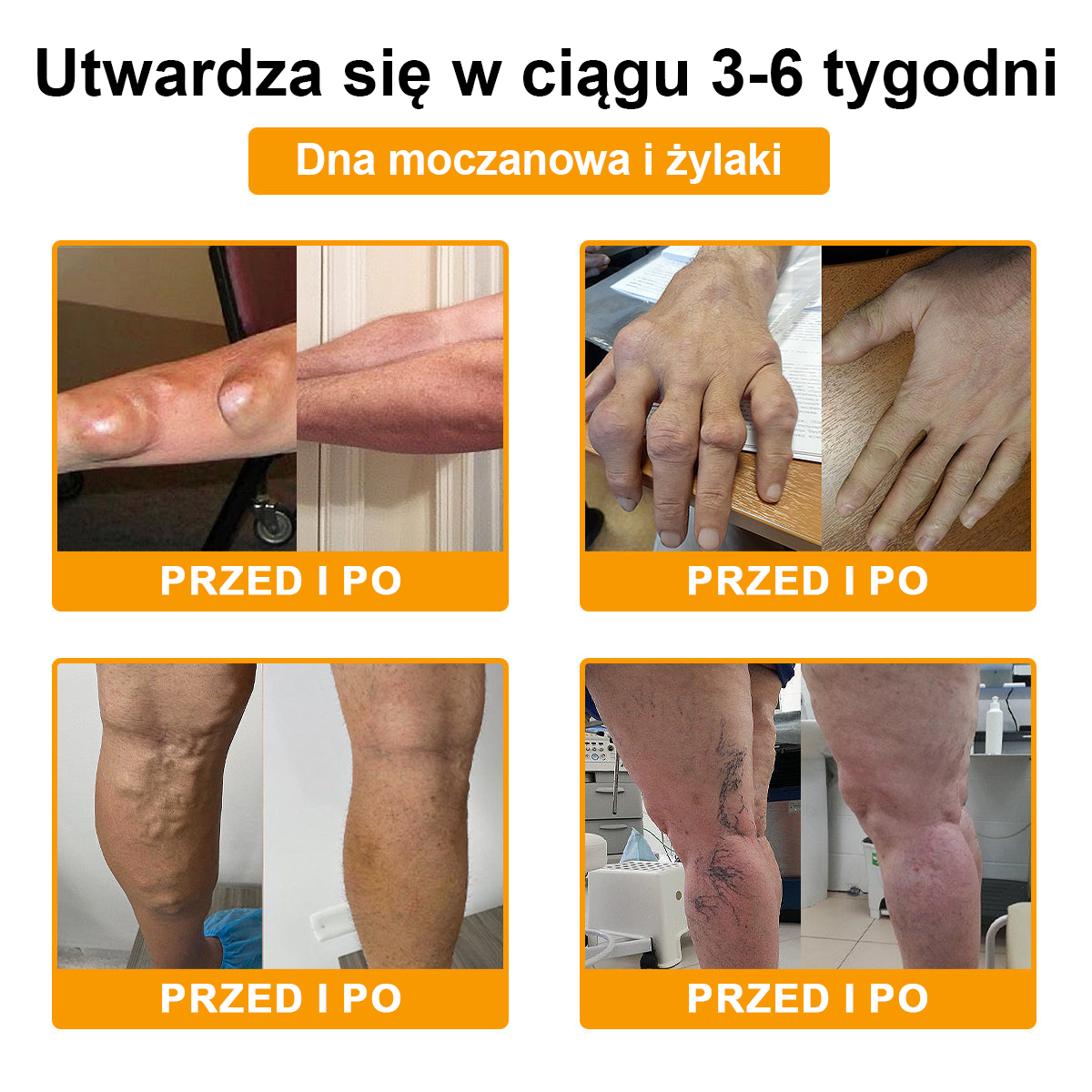 🦴TLOPA® Toksyna botulinowa i jad pszczeli Krem przeciwbólowy do gojenia kości🦴