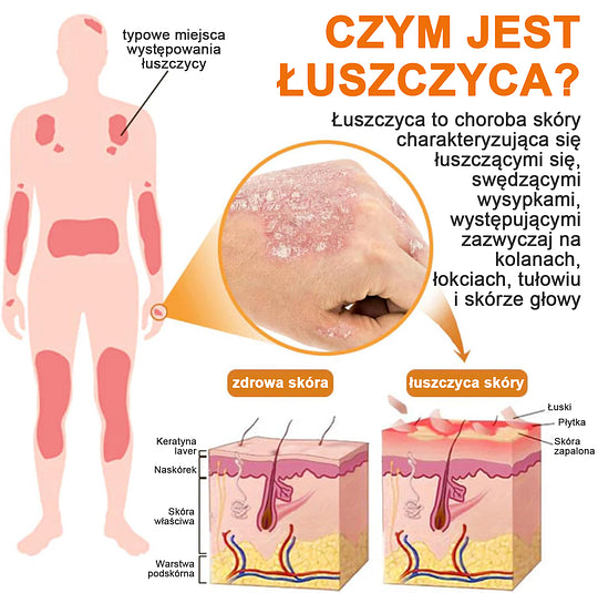 (🔥Płatność przy odbiorze🔥60% zniżki) LOVILDS™ PsoriaHeal Spray na łuszczycę (wysyłka na cały świat – bezpłatna wysyłka)🌐