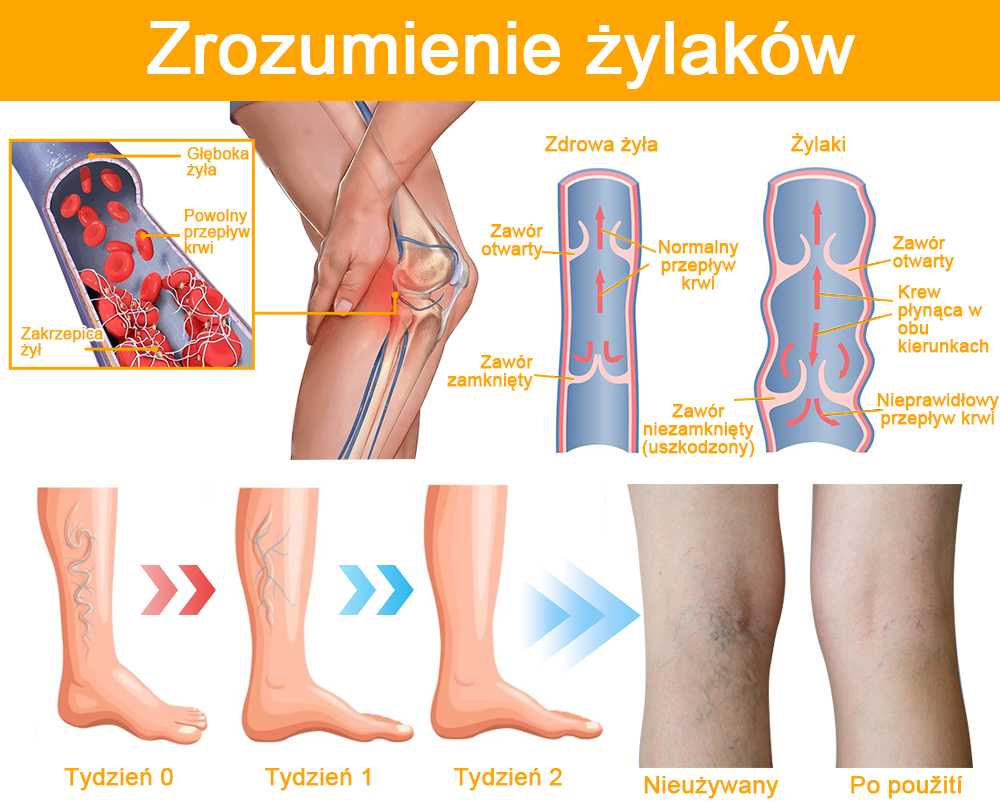 Fuzero™ Spray na żylaki z jadem pszczelim 🐝 🐝 🐝