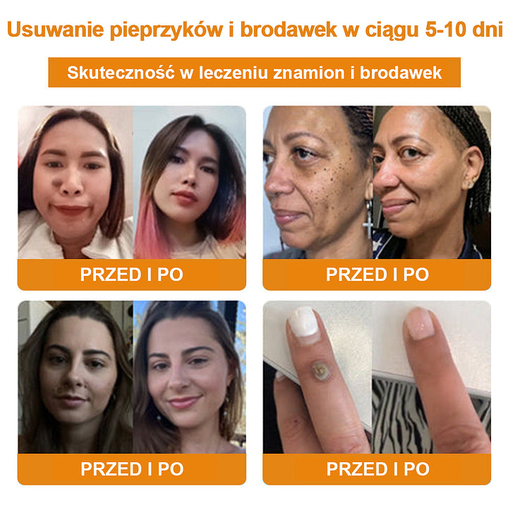 【🌊 Za pobraniem🌊 】 Vsoxa™ Krem do usuwania brodawek i pieprzyków z jadem pszczelim (👨⚕Zalecenia AAD) 🐝🐝 (🔥Ostatni dzień wyprzedaży 70% taniej)