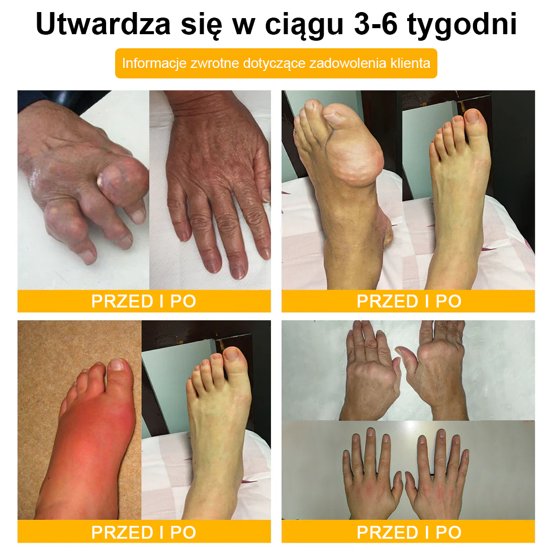 🦴TLOPA® Toksyna botulinowa i jad pszczeli Krem przeciwbólowy do gojenia kości🦴