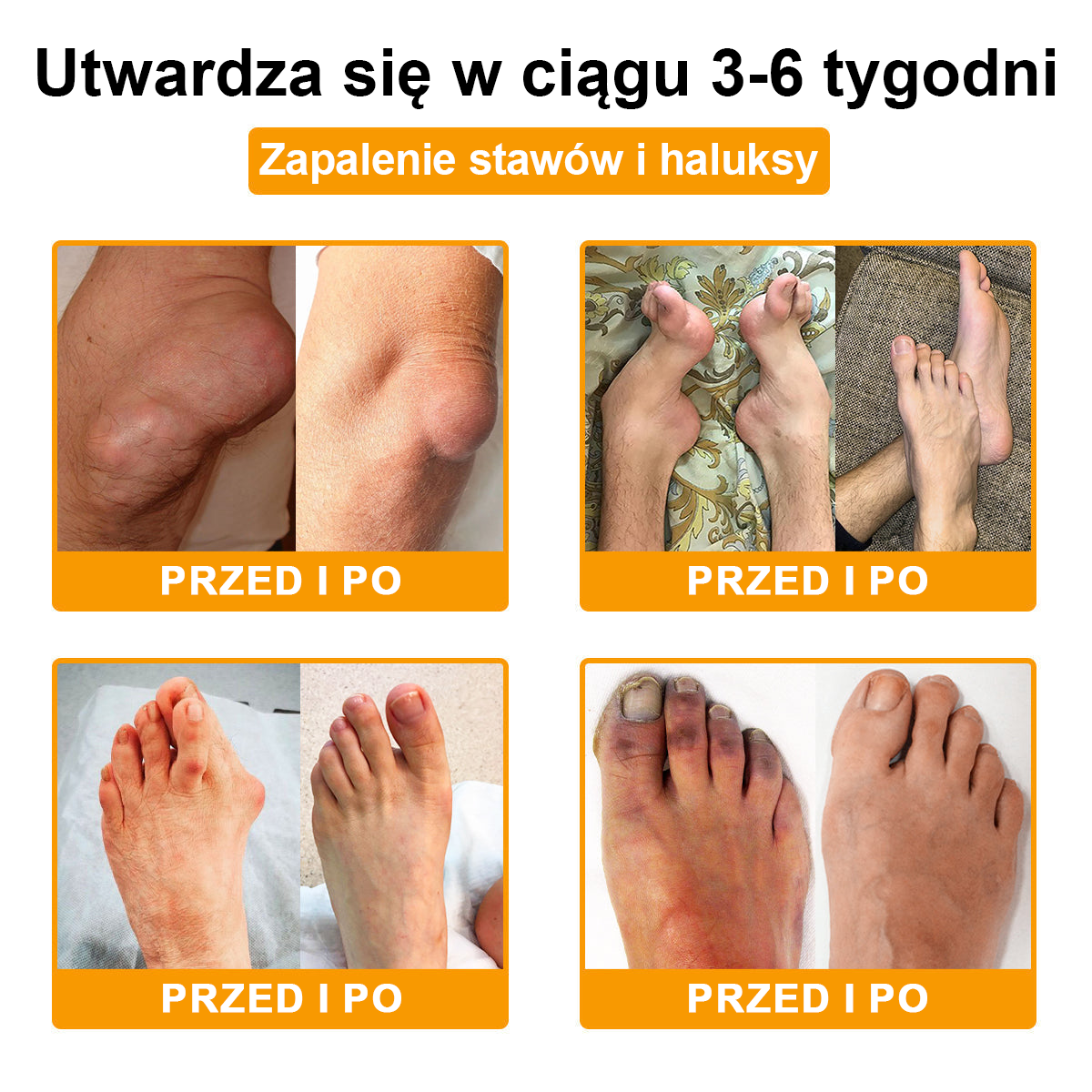 🦴TLOPA® Toksyna botulinowa i jad pszczeli Krem przeciwbólowy do gojenia kości🦴