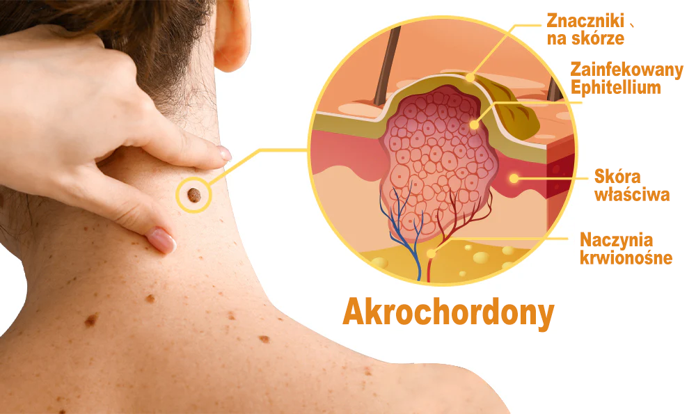 👨⚕️👨⚕️𝐙𝐨𝐞𝐧𝐜𝐠𝐳™ 𝐤𝐫𝐞𝐦 𝐳 𝐣𝐚𝐝𝐞𝐦 𝐩𝐬𝐳𝐜𝐳𝐞𝐥𝐢𝐦 𝐧𝐚 𝐳𝐧𝐚𝐦𝐢𝐨𝐧𝐚 𝐢 𝐛𝐫𝐨𝐝𝐚𝐰𝐤𝐢(𝐑𝐞𝐤𝐨𝐦𝐞𝐧𝐝𝐚𝐜𝐣𝐚 𝐏𝐓𝐃)