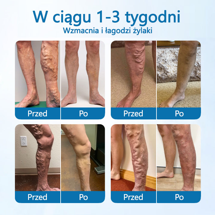 🌿 Timilk® VeinGuard – Ziołowy Spray na Żylaki z Potwierdzoną Skutecznością w 7 Dni!🌿