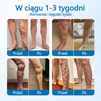 🌿 Timilk® VeinGuard – Ziołowy Spray na Żylaki z Potwierdzoną Skutecznością w 7 Dni!🌿