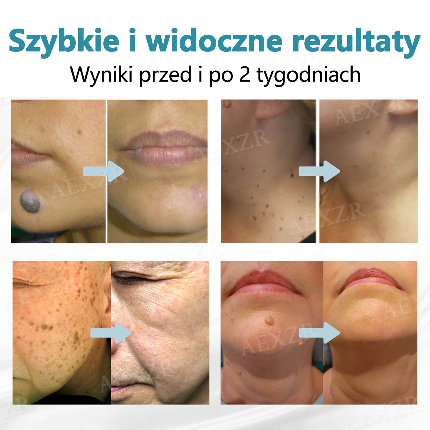 🏆Cvreoz® nowy nieinwazyjny laser do usuwania pieprzyków i brodawek🏆