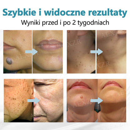 🏆Cvreoz® nowy nieinwazyjny laser do usuwania pieprzyków i brodawek🏆