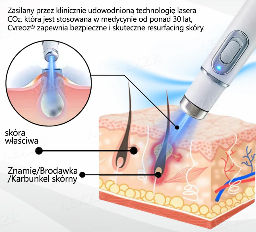 🏆Cvreoz® nowy nieinwazyjny laser do usuwania pieprzyków i brodawek🏆
