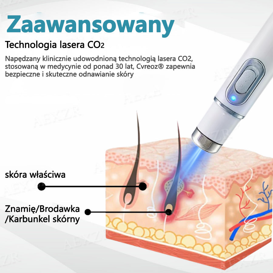 🏆Cvreoz® nowy nieinwazyjny laser do usuwania pieprzyków i brodawek🏆