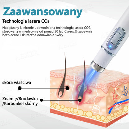 🏆Cvreoz® nowy nieinwazyjny laser do usuwania pieprzyków i brodawek🏆